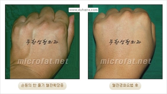 [두한성형외과 경쟁력 정맥류 치료] - [손, 손등, 손목혈관확장증, 팔혈관확장증에 질문과 답변] 관련 이미지 8