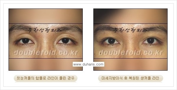 [두한성형외과 경쟁력 쌍꺼풀 재수술, 극한 재수술] - [미세지방이식으로 풀린 쌍꺼풀 교정] 관련 이미지 1
