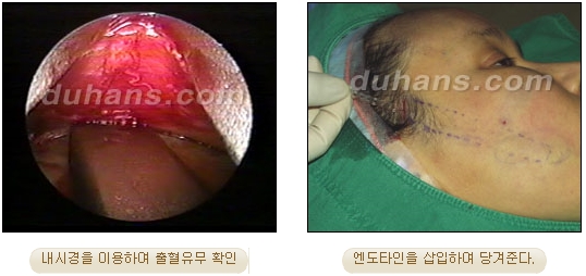 두한성형외과 안티에이징 리프팅 - 엔도타인 리프팅 관련 이미지 12