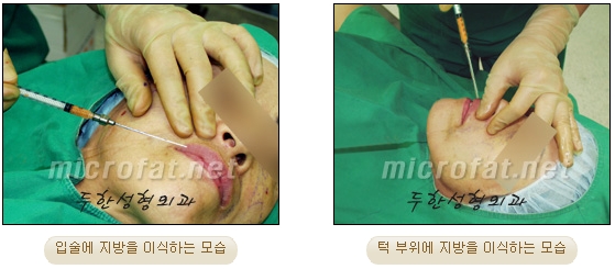 [Duhan Plastic Surgery Lip Surgery] - [Lip Correction Fat Grafting] image 7