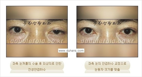 ⁠⁠[두한성형외과 경﻿쟁력 쌍꺼풀 재수술] - [안검하수(졸리운 눈매) 종류와 교정 방법 안내] 관련 이미지 6