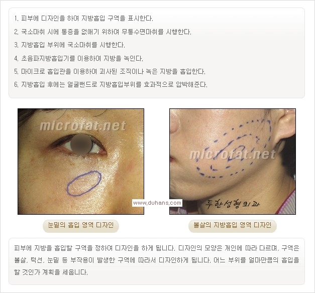 [두한성형외과 경쟁력 미세지방이식] - [타병원에서의 미세지방이식 이후 부작용 교정의 대상 안내] 관련 이미지 12