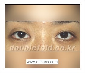 [두한성형외과 경쟁력 쌍꺼풀 재수술] - [쌍꺼풀 재수술의 대상과 해당 쌍꺼풀 재수술 방법 안내] 관련 이미지 3