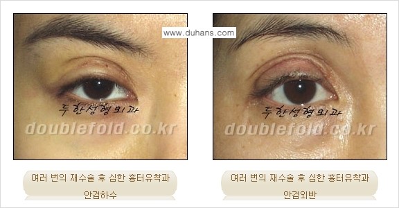 [두한성형외과 무한 경쟁력 "극한 눈(쌍꺼풀) 재수술"] - [극한 눈(쌍꺼풀) 재수술 Q&A] 관련 이미지 9