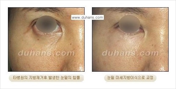 [두한성형외과 경쟁력 눈밑성형] - [과도한 눈밑지방제거의 부작용 후 눈밑지방재배치] 관련 이미지 2