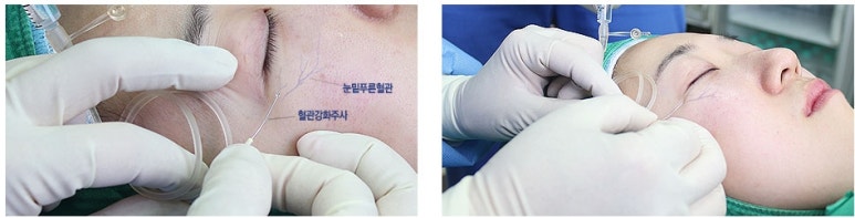 두한성형외과 눈밑수술 - 다크서클 수술 전후 관리 안내 관련 이미지 96