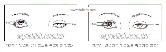 [두한성형외과 경쟁력 쌍꺼풀 재수술] - [안검하수 수술] 관련 이미지 6