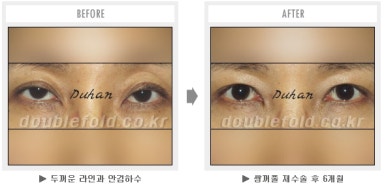 두한성형외과 쌍커풀 재수술 - 짝눈 눈매교정, 가성 안검하수 교정과 뒤밑트임 관련 이미지 56