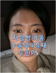 [두한ps]- #쌍꺼풀 처음수술 #완전절개 #답답해보이는 눈매교정 관련 이미지 3