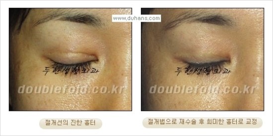 [두한성형외과 경쟁력 눈성형] - [쌍꺼풀 재수술 대상과 재수술의 문제점, 미운쌍꺼풀, 재수술 방법들] 관련 이미지 82