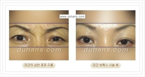 [두한성형외과 경쟁력 Quick성형] - [주름교정을 위한 간편한 보톡스(보툴리눔톡신) 시술 안내] 관련 이미지 7