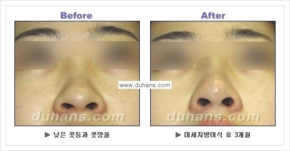 [두한성형외과 경쟁력 코성형] - [코높힘 미세지방이식 정보 안내] 관련 이미지 5