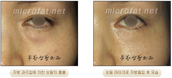 [Duhan Plastic Surgery Liposuction] - [Facial Liposuction] image 37