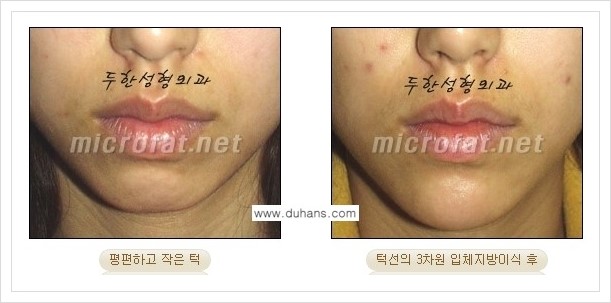 [두한성형외과 경쟁력 안면윤곽 교정] - [미세지방이식으로 무턱, 작은턱, 오목턱, 턱선의 비대칭 교정 안내] 관련 이미지 16