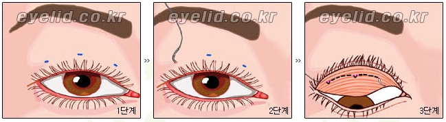 [두한성형외과 눈성형] - [쌍꺼풀수술의 절개법, 매몰법] 관련 이미지 7