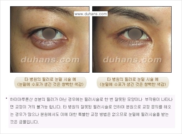 [두한성형외과 간단 주사요법] - [필러에 대하여 올바로 알아야 할 지식 안내] 관련 이미지 8