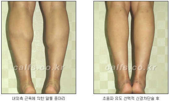 [두한성형외과 종아리퇴축술] - [NO절개! 초음파유도신경차단술] 관련 이미지 26