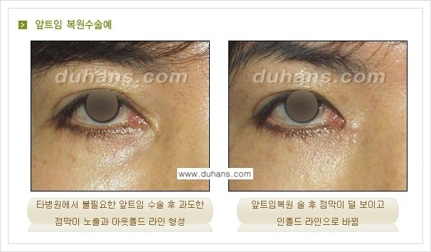 [두한성형외과 경쟁력 눈성형] - [흉터없는 몽고주름 제거 - 앞트임 수술 안내] 관련 이미지 4