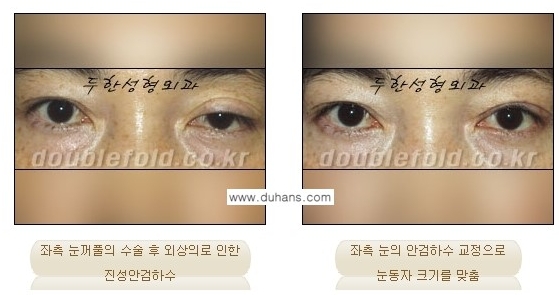 [두한성형외과 경쟁력 눈성형] - [안검하수(졸리운 눈매)의 종류와 교정 방법 안내] 관련 이미지 6
