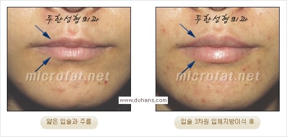 [두한성형외과 경쟁력 미세지방이식] - [입체 미세지방이식으로 주름을 펴면서 볼륨감 있는 입술 만들기] 관련 이미지 8