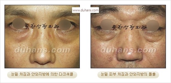 [두한성형외과 경쟁력 안검성형] - [젊어 보이면서 개선된 인상을 주기 위한 성형] 관련 이미지 1