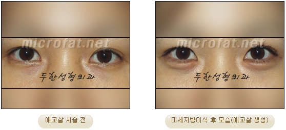 ​[두한성형외과 지방이식] - [애교살] 관련 이미지 26