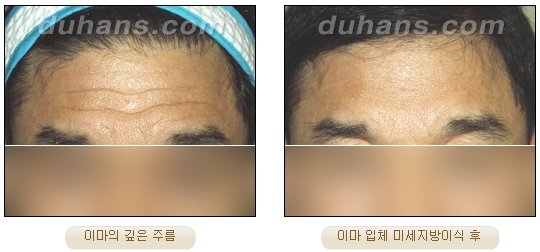 [두한성형외과 주름개선] - [주름교정 방법] 관련 이미지 15