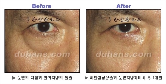 [두한성형외과 경쟁력 동안성형 리더] - ​[미간주름, 이마주름, 안검성형, 이마거상술, 눈썹거상술] 관련 이미지 71