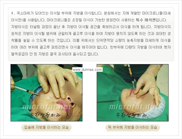 [두한성형외과 경쟁력 미세지방이식] - [입술 미세지방이식 안내 1.] 관련 이미지 7