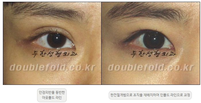 [Double Eyelid Surgery Duhan Plastic Surgery] - [Revision Methods] image 5