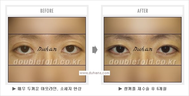 [두한성형외과 경쟁력 쌍꺼풀 재수술, 극한 눈재수술] - [망친 쌍꺼풀, 망가진 쌍꺼풀 복원수술, 재수술의 성공요건] 관련 이미지 8