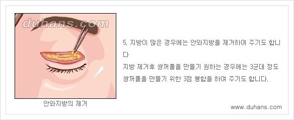 [두한성형외과 경쟁력 눈성형] - [상큼하고 환한 눈매! 상안검 성형(윗눈꺼풀 처짐) 안내] 관련 이미지 5