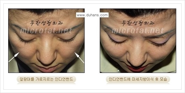 [두한성형외과 경쟁력 미세지방이식] - [귀족수술과 인디언밴드 교정 안내] 관련 이미지 13
