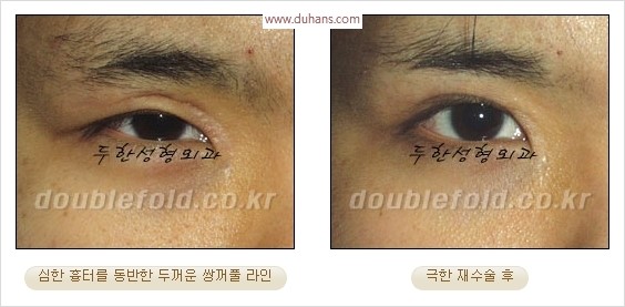 [두한성형외과 경쟁력 눈성형] - [극한 재수술, 함몰된 눈꺼풀 라인교정, 안검하수(졸리운 눈매)] 관련 이미지 18