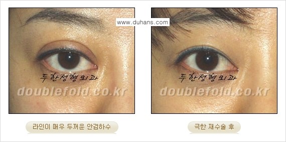 [두한성형외과 NO.1 "극한 눈 재수술"] - [극한 눈 재수술 성공사례 ①] 관련 이미지 14