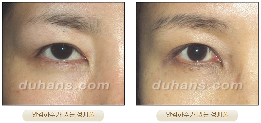 [DuHan Plastic Surgery Eye Surgery] - [Double Eyelid Surgery Guide] image 15