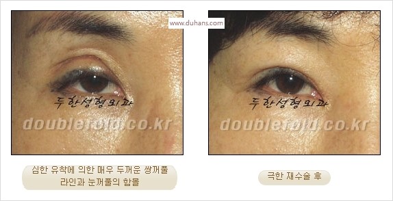 [두한성형외과 경쟁력 쌍꺼풀 재수술 스페셜] - [망가진 라인을 교정하는 극한 재수술] 관련 이미지 4