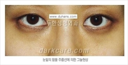 [두한성형외과 경쟁력 눈밑성형] - [다크써클의 원인과 다크써클의 종류] 관련 이미지 6