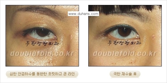 [두한성형외과 경쟁력 눈성형] - [극한의 상태에서 쌍꺼풀재수술(눈재수술) 안내] 관련 이미지 17