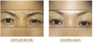 [Wrinkle Correction, Duhan Plastic Surgery] - [Wrinkle Botox, Wrinkle Filler, Wrinkle Fat Grafting] image 8