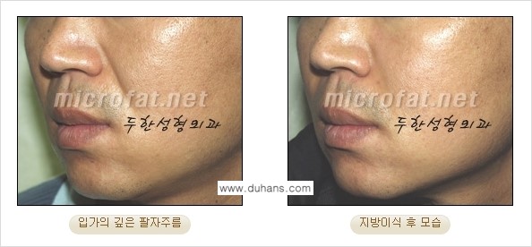 [두한성형외과의 경쟁력 있는 지방이식] - [입가주름, 팔자주름 미세지방이식 1.] 관련 이미지 6