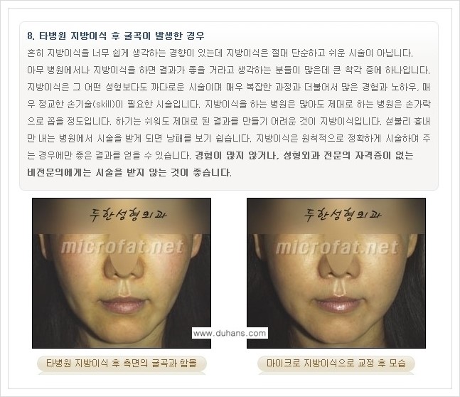 [두한성형외과 경쟁력 볼살지방이식] - [타병원 지방이식 후 - 굴곡이 발생한 경우, 과주입으로 인해 볼살이 불룩한 경우 안내] 관련 이미지 1