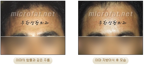 [두한성형외과 이마성형] - [엔도타인리프팅, 이마지방이식]​ 관련 이미지 28