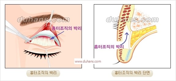 [두한성형외과 경쟁력 눈성형] - [완전절개법(Full incision method)의 재수술 과정] 관련 이미지 3