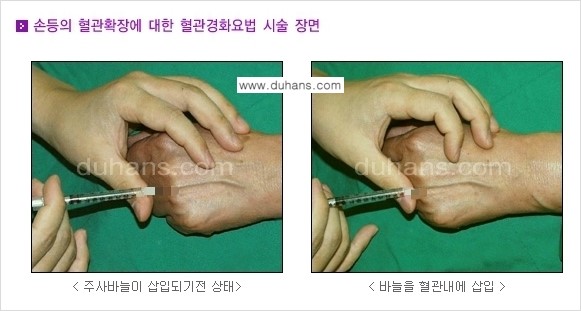 [두한성형외과 정맥 혈관 확장으로 인한 피부개선] - [손, 팔 혈관 확장] 관련 이미지 8