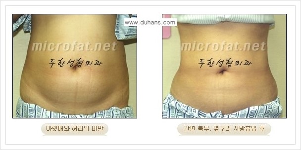 [두한성형외과 경쟁력 바디성형] - [하복부, 팔뚝, 허리선, 허벅지, 엉덩이 간편지방흡입술] 관련 이미지 16