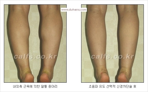[두한성형외과 Dr. 컬럼] - [종아리 근육퇴축술로 가장 선호하는 비절개 초음파 유도 선택적 신경차단술] 관련 이미지 8