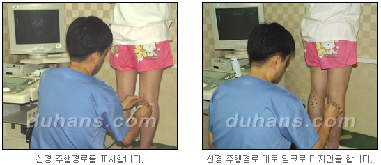 [두한성형외과 종아리 퇴축] - [종아리 퇴축술 재발 재수술] 관련 이미지 5