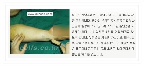 [두한성형외과 경쟁력 멀티종아리성형] - [종아리성형 방법별 전후 주의사항] 관련 이미지 22
