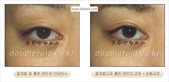 [두한성형외과 경쟁력 눈성형] - [쌍꺼풀 재수술에 대한 최선의 대안 제시] 관련 이미지 80